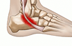 Peroneal tendon attenuation