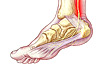 Posterior tibial insertional tendonitis