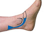 Posterior tibial tendon dysfunction