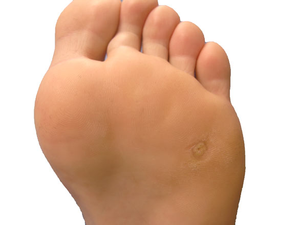 Wart foot bottom. Wart on foot side, Aplicator lyapko utilizarea în varicoase