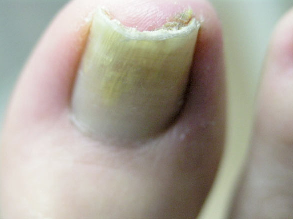 Fungal toenails - View 1