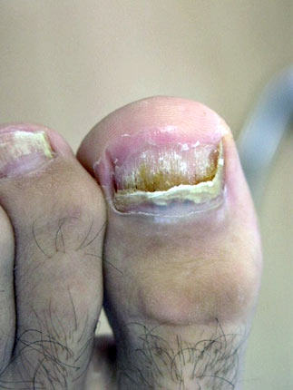 Fungal toenails - View 3
